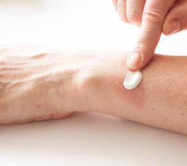 Treatment of burns on female hand on white