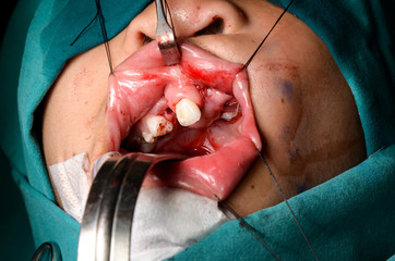 Young patient with cleft lip and cleft palate are treated by surgeons in operating room at the hospital. Children with cleft lip and cleft palate are treated by surgeons.