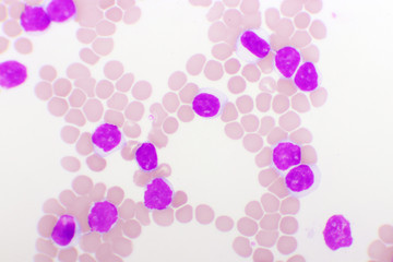 Blood picture of chronic lymphocytic leukemia or CLL, analyze by microscope, original magnification...