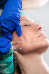 Meso Threads Face Lifting Treatment. Mesotherapy in Aesthetic Medicine