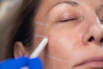 Aesthetic Mesotherapy Thread Face Lifting. Anti-aging Cosmetic Treatment
