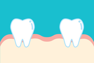 抜歯した歯のイラスト Illustration of removal of tooth