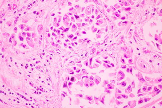 Section tissue of breast cancer view in microscopy.Ductal cell carcinoma.