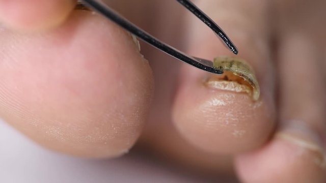 Close-up of doctor's hand examining a deformed nail that comes off a man&rsquo;s foot