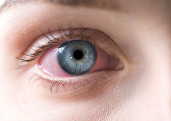Macro of red woman eye. Bloodshot eye - conjunctivitis or allergic reaction.