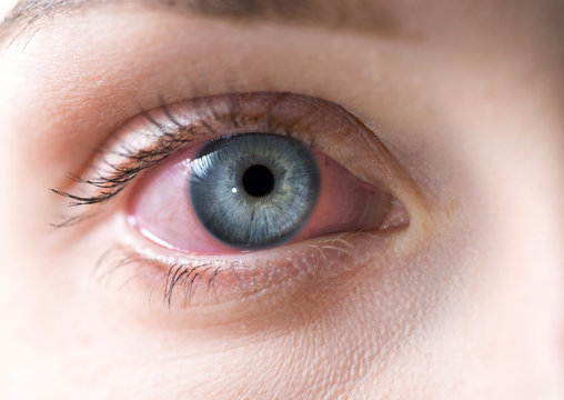 Macro Of Red Woman Eye. Bloodshot Eye - Conjunctivitis Or Allergic Reaction.