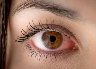 Macro of red woman eye. Bloodshot eye - conjunctivitis or allergic reaction.