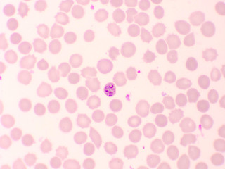 Fototapeta na wymiar Malaria parasite in red blood cells, ring form stage of Plasmodium falciparum, original magnification 1000x
