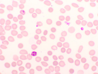 Fototapeta na wymiar Malaria parasite in red blood cells, ring form stage of Plasmodium falciparum, original magnification 1000x