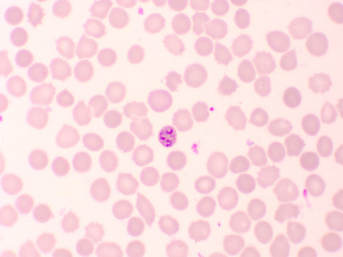 Malaria parasite in red blood cells, ring form stage of Plasmodium falciparum, original magnification 1000x