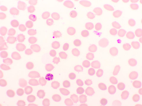 Malaria parasite in red blood cells, ring form stage of Plasmodium falciparum, original magnification 1000x
