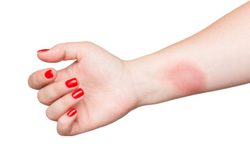 Burn on female hand with red nails isolated on white background.