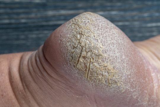 Chapped human foot heel, crack heel pictures closeup. Dry and cracked skin on the heel