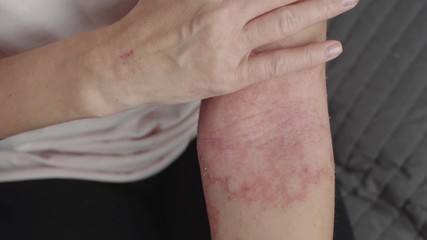 allergic dermatitis on the arms