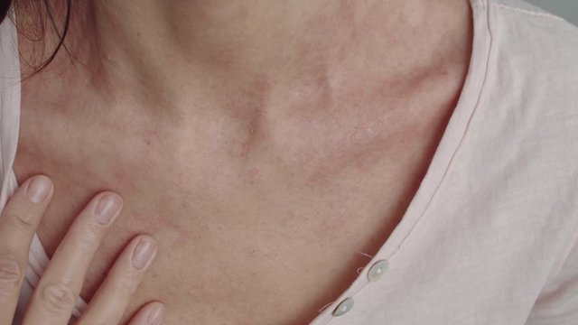 dermatitis on the skin of the neck