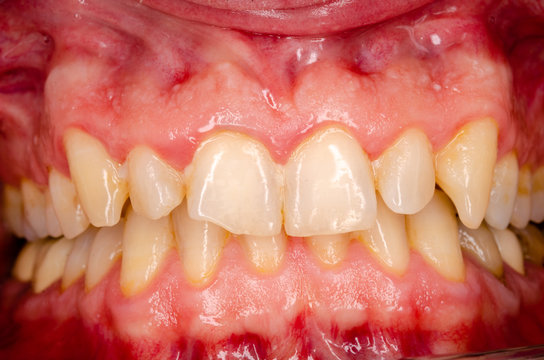 entz&uuml;ndung des gingivalsaumes durch bakterielle bel&auml;ge
