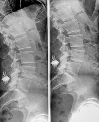 Spine and pelvis of a human body on x-ray. Two different split views.