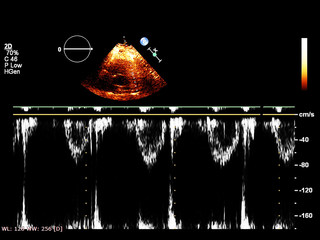 Screen of echocardiography (ultrasound) machine.