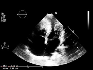 Screen of echocardiography (ultrasound) machine.