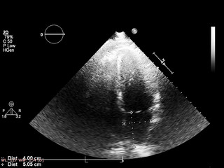 Screen of echocardiography (ultrasound) machine.