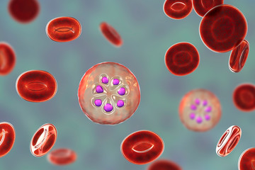 The malaria-infected red blood cell. 3D illustration showing parasite Plasmodium malariae in the schizont stage