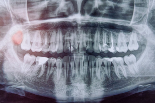 Panoramic x-ray scanning of human teeth. Female teeth with one wisdom tooth highlighted in red