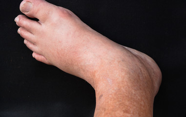 Swollen left foot of a 79-year old male.