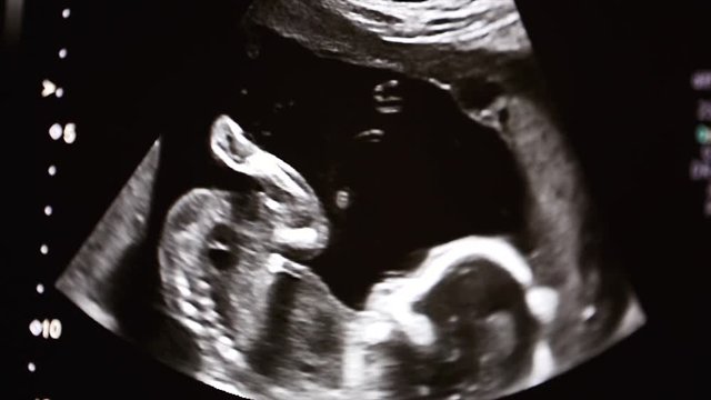 Ultrasound machine screen with unborn baby on it
