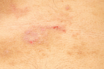 Closeup image of a male body suffering from chronic skin rash. Food allergy rash.
