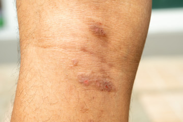 Closeup image of a male body suffering from chronic skin rash. Food allergy rash.