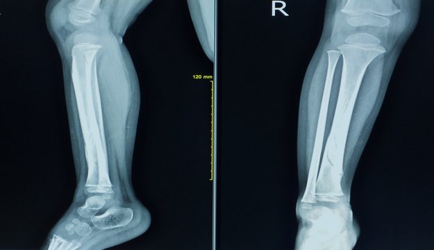 X-ray right leg lateral view a boy 3 year old.Showing fracture distal shaft tibia.