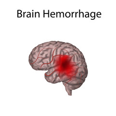 Cerebral, brain hemorrhage. Bleeding. Blood. Medical illustration.