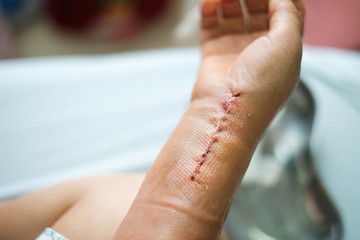 Hands of woman. Stitches that are being treated