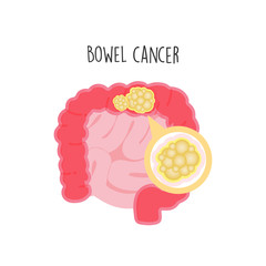 Bowel Cancer flat vector illustration.