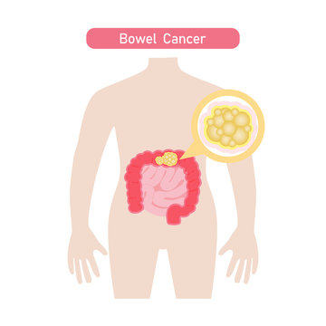 Bowel cancer diagram .Vector illustration in flat style.