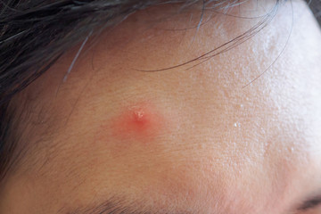 Naklejka premium Inflammatory acne with red spot on face closeup