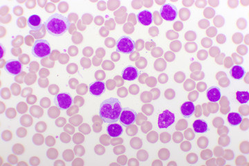 Blood picture of chronic lymphocytic leukemia or CLL, analyze by microscope, original magnification 1000x