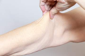 A senior elderly woman holding, pulling the skin on her arm with bad turgor, exces loose skin