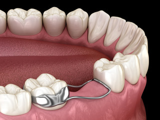 Space Maintainer Unilateral keeps from teeth shift deformatiuon after losing molar tooth. 3D illustration