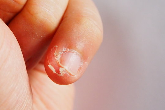 Nail Pathologies - Findings in or Near Nails Paronychia A superficial  infection of the proximal and la… | Nail health, Nail diseases and  disorders, Nail problems