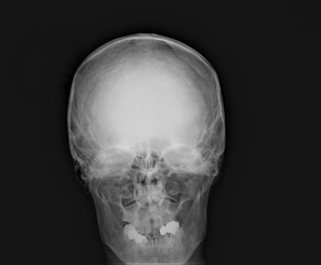 normal x-ray of the skull in direct projection, medical diagnostics, traumatology and orthopedics, neurosurgery