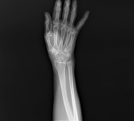 normal radiography of hand and wrist bones, traumatology and orthopedics, traumatology, sports...