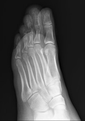 normal radiography of the foot, medical diagnostics, traumatology and orthopedics