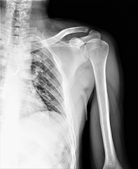 normal radiography of the shoulder joint in direct projection, traumatology and orthopedics, traumatology, sports injury