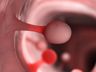 3d rendered medically accurate illustration of colon polyps
