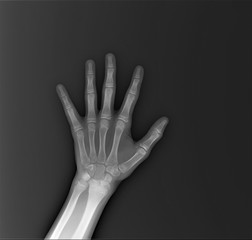 normal x-ray of the hand bones and fingers,orthopedics, medical diagnostics, rheumatology