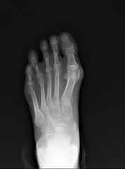 normal radiography of the foot, medical diagnostics, traumatology and orthopedics