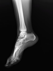 normal radiograph of the ankle joint