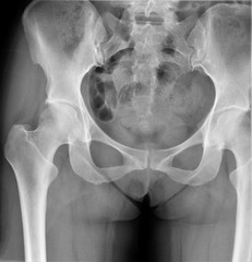 radiograph of the hip joint,medicine,diagnostic,ottopedia