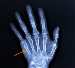 on the x-ray of the hand fracture of the fifth metacarpal bone, traumatology, medical diagnosis